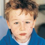 Molluscum contagiosum hos barn Molluscum contagiosum hos barn