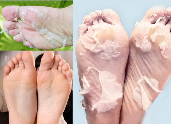 Cream of calluses och corns