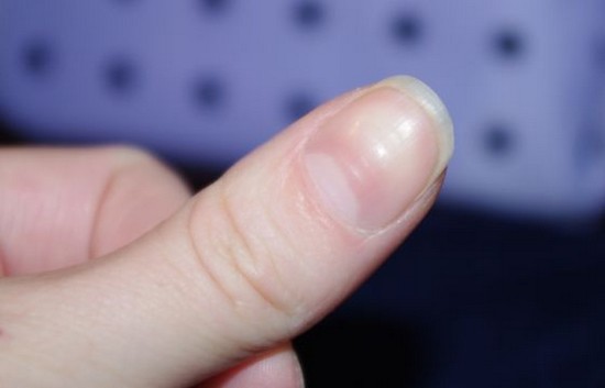 Cuticle borttagning