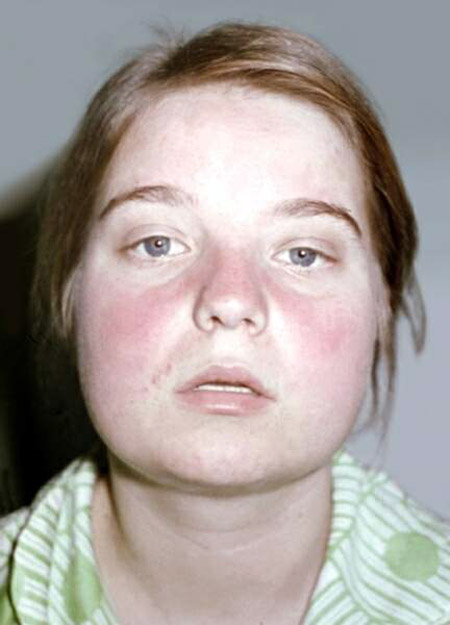 Vad är lupus? Symtom och orsaker till sjukdomen