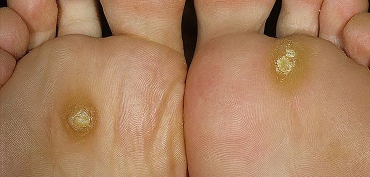 Problem med corns och calluses? Leta efter lösningen här!