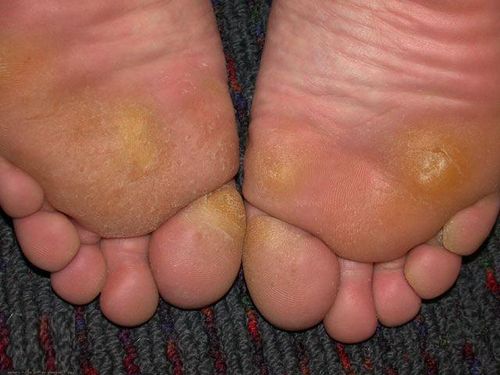 Problem med corns och calluses? Leta efter lösningen här!