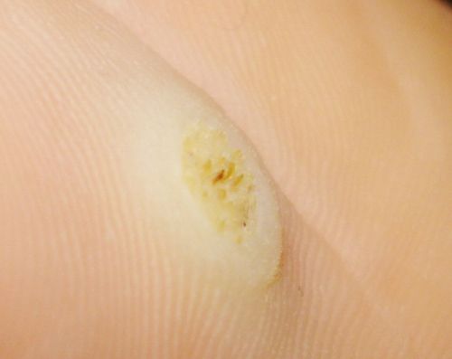 Problem med corns och calluses? Leta efter lösningen här!