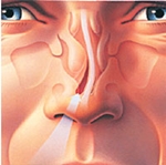 Hur man behandlar krökningen i nasal septum: kirurgi, laserkorrigering