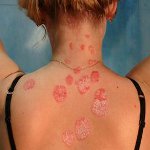 Hur man behandlar psoriasis? Hur man behandlar psoriasis?