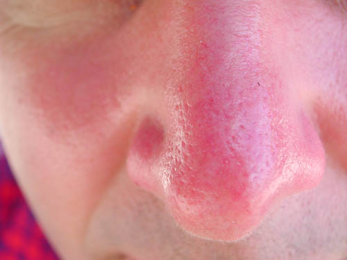 Huden är bränd i solen. Vad ska jag göra? Recept, masker, tips