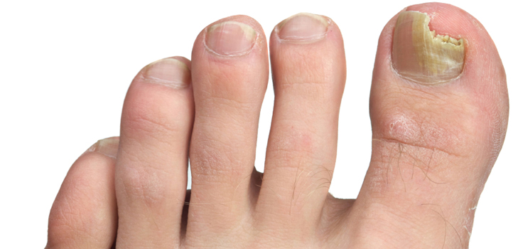De bästa lösningarna för nagelsvamp på ben och händer