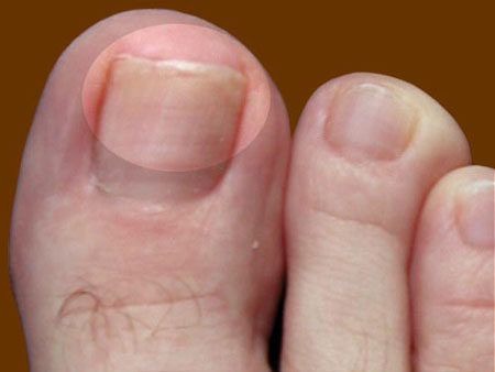 De bästa lösningarna för nagelsvamp på ben och händer