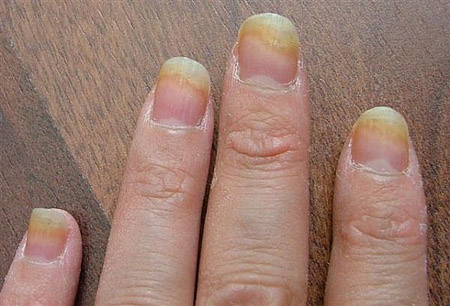 De bästa lösningarna för nagelsvamp på ben och händer